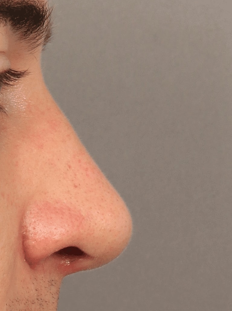 Alarplasty Nostril Reduction Before & After