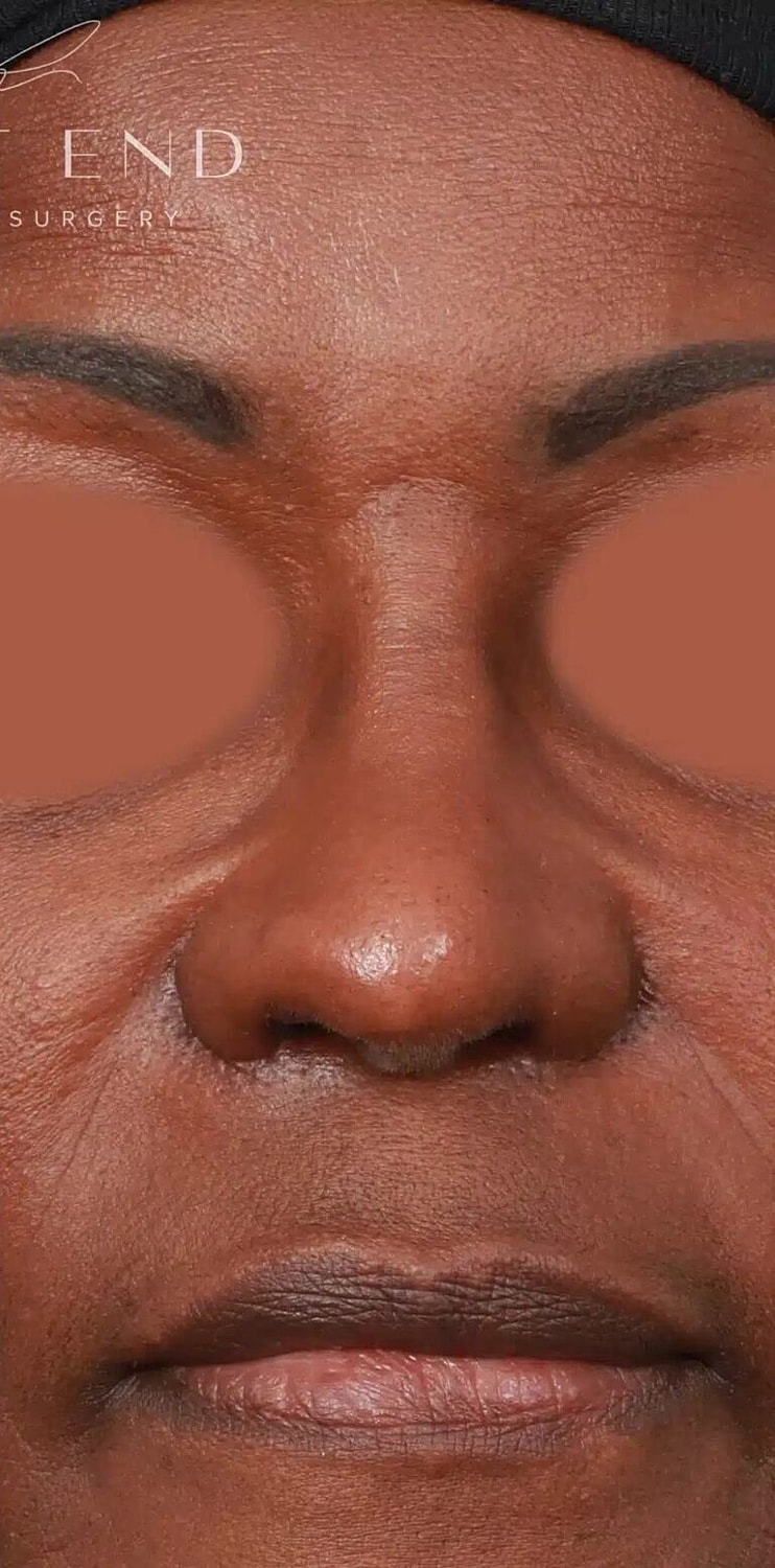 Alarplasty Nostril Reduction Before & After