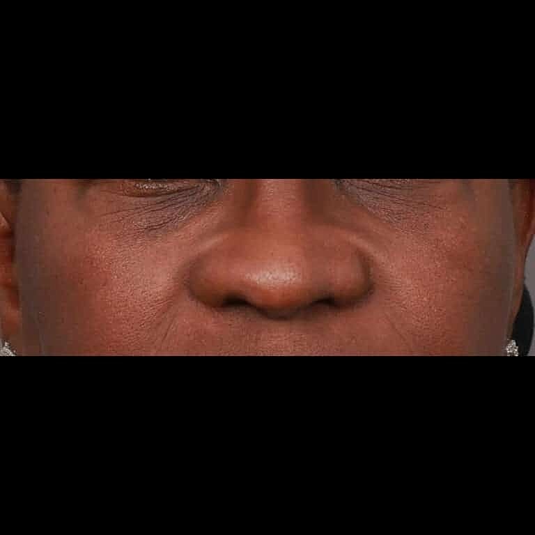 Alarplasty Nostril Reduction Before & After