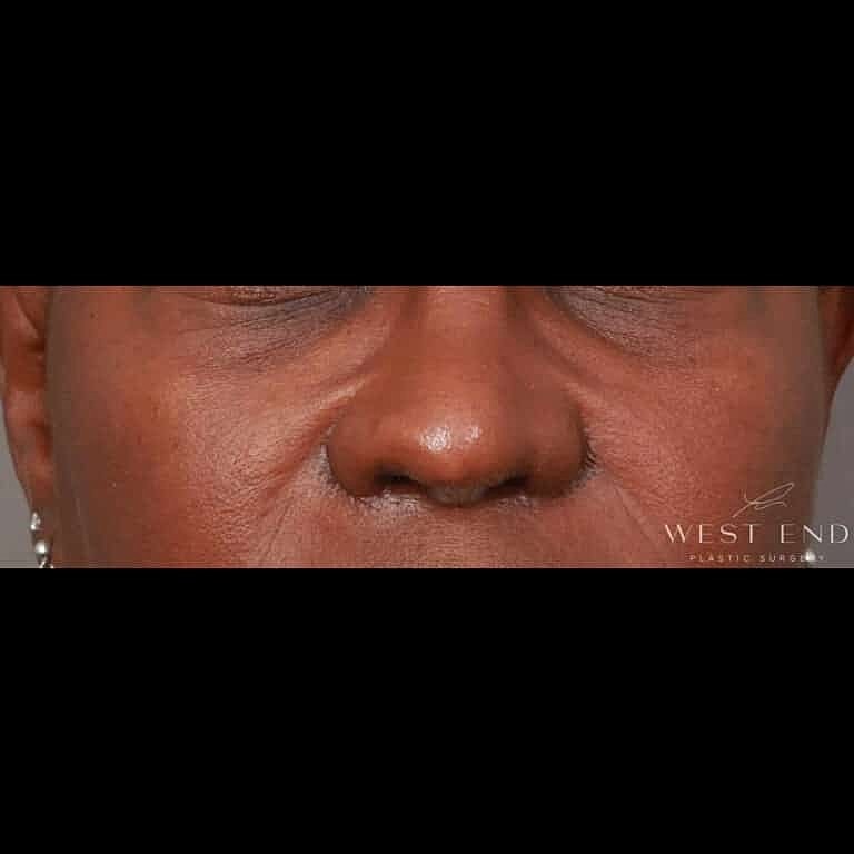 Alarplasty Nostril Reduction Before & After