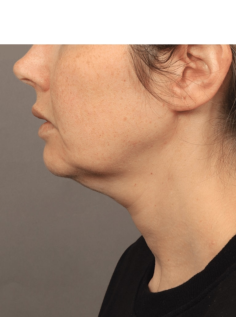 Facelift Before & After