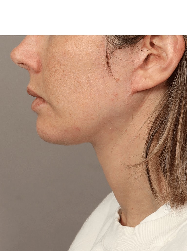 Facelift Before & After