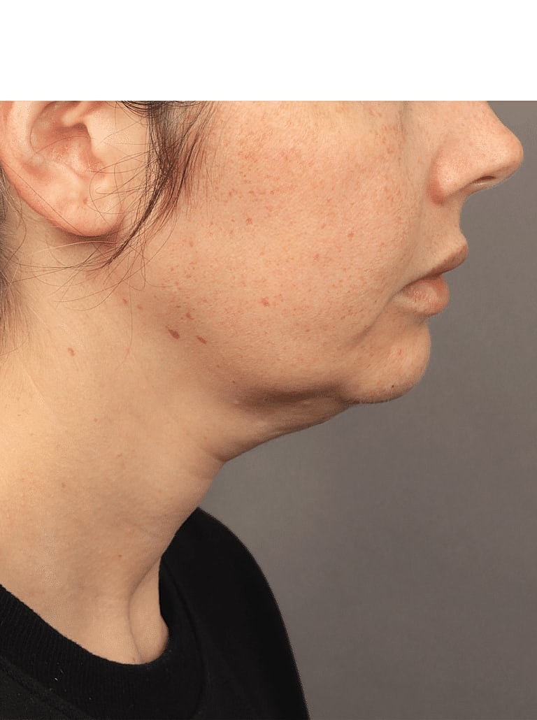 Facelift Before & After