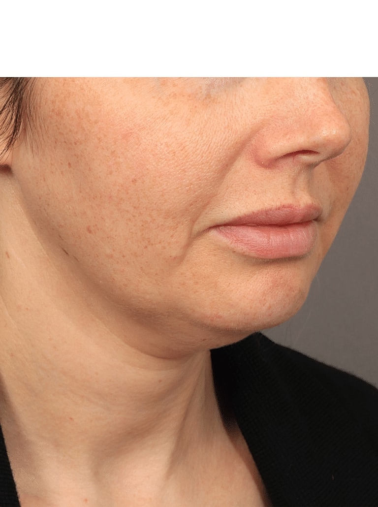 Facelift Before & After