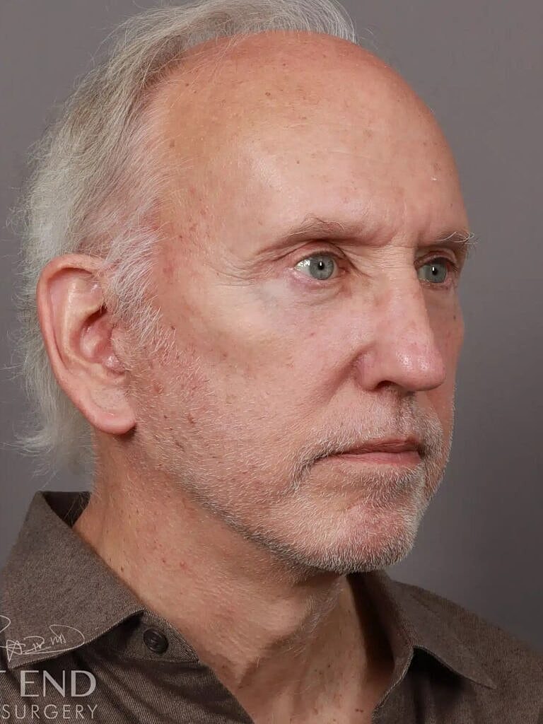 Facelift Before & After