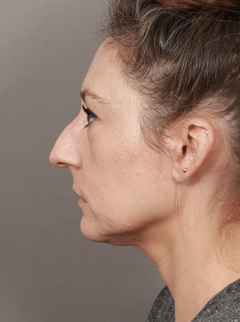 Facelift Before & After