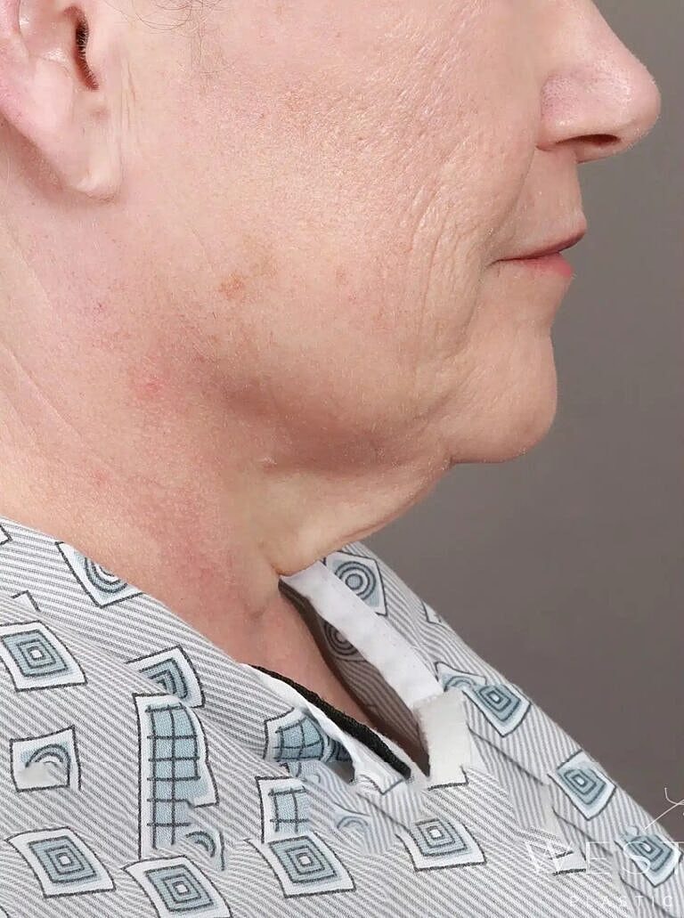 Facelift Before & After