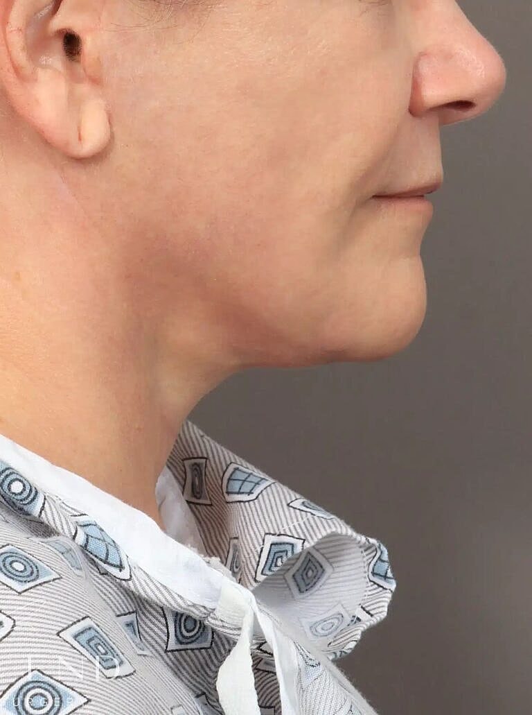 Facelift Before & After