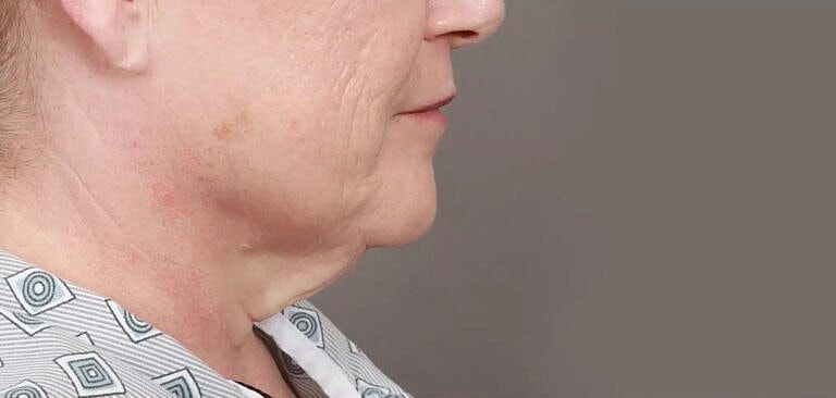 Facelift Before & After