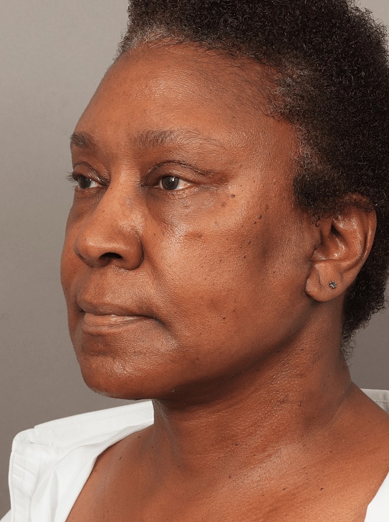 Facelift Before & After