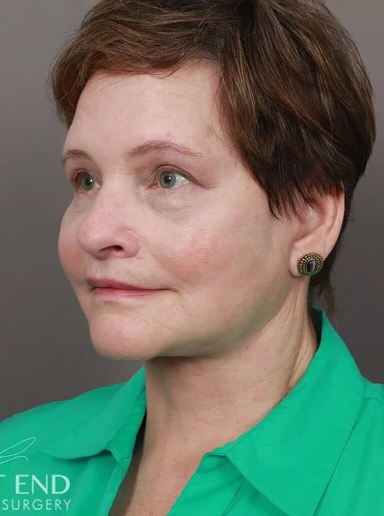 Facelift Before & After