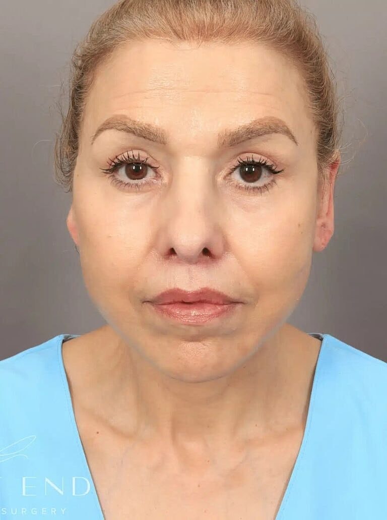 Facelift Before & After