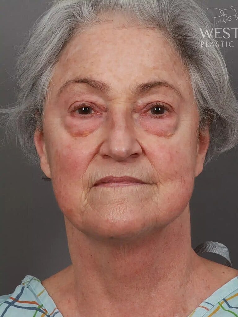 Facelift Before & After