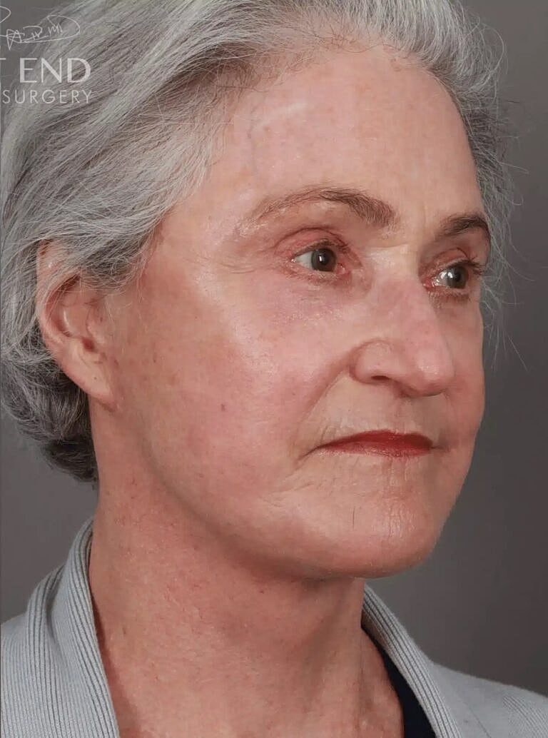 Facelift Before & After