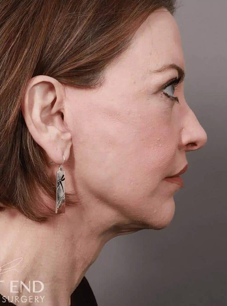 Facelift Before & After