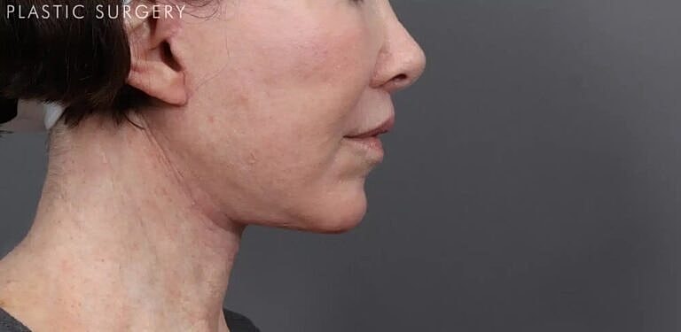 Facelift Before & After