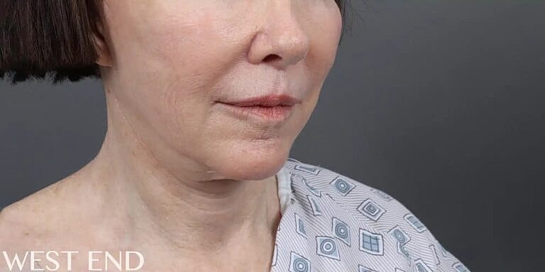 Facelift Before & After