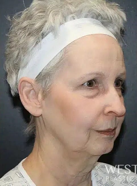 Facelift Before & After