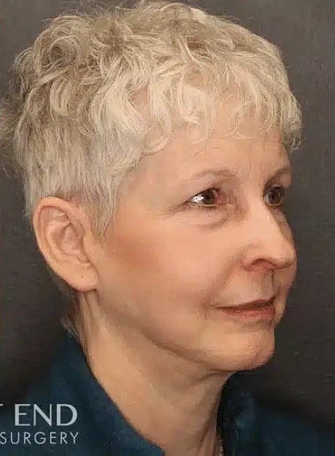 Facelift Before & After