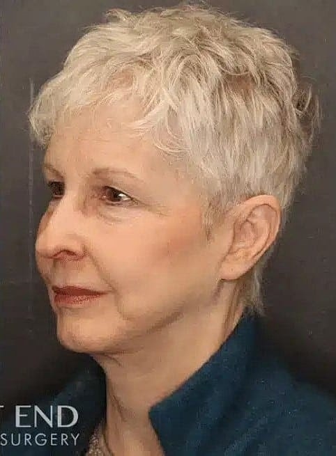 Facelift Before & After