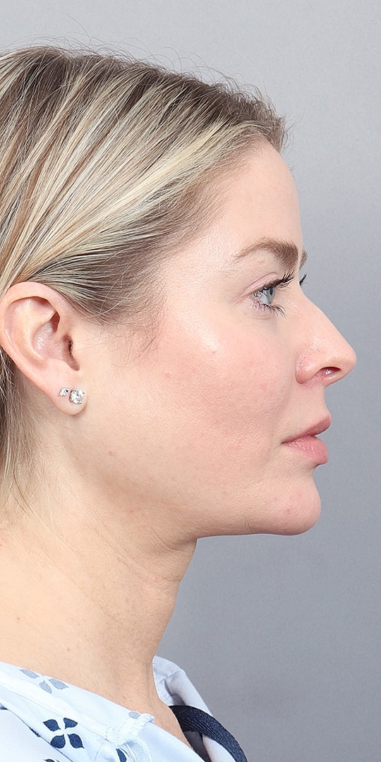 Facelift Before & After