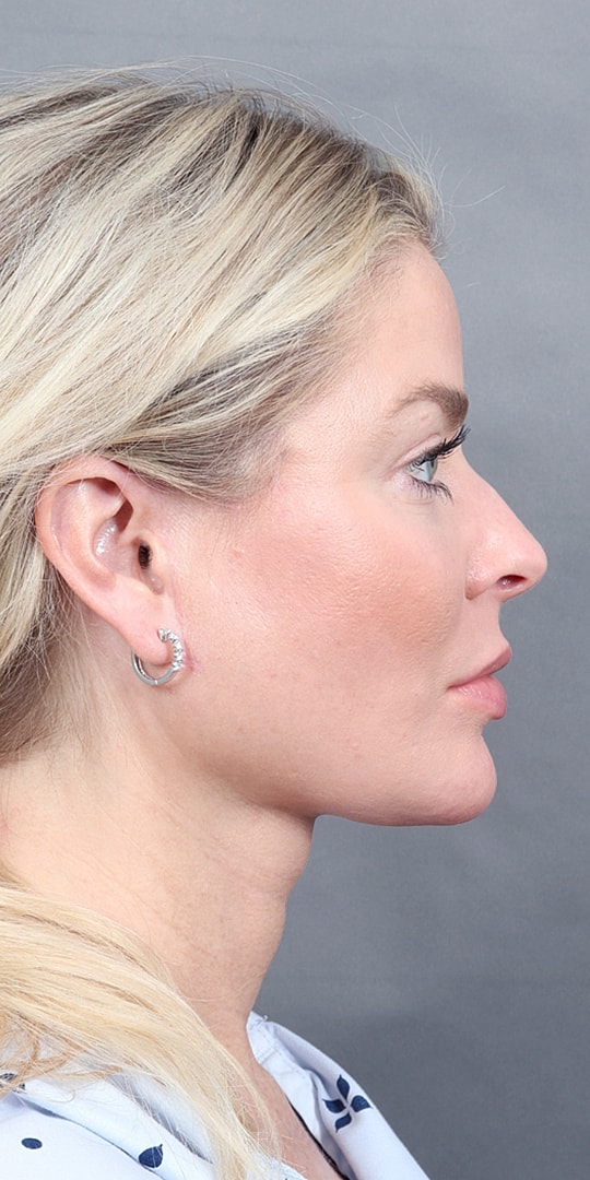 Facelift Before & After