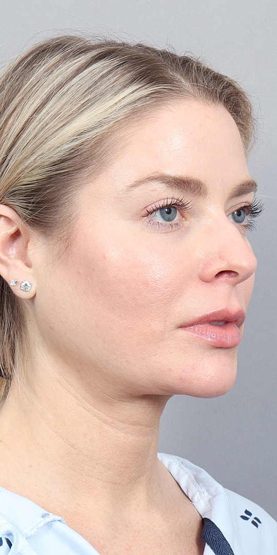 Facelift Before & After