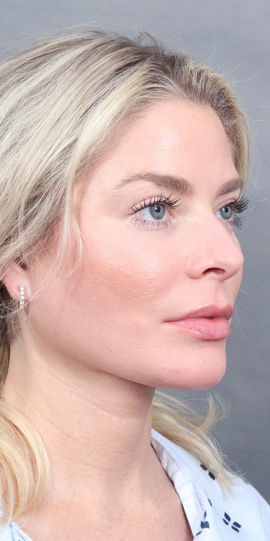 Facelift Before & After