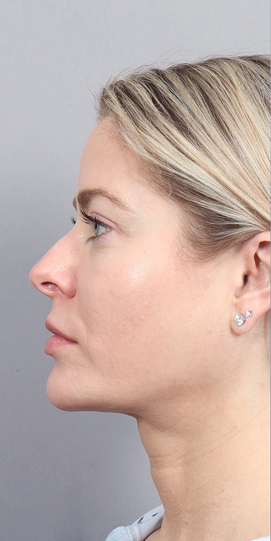 Facelift Before & After