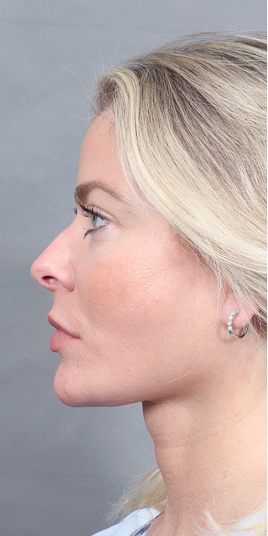 Facelift Before & After