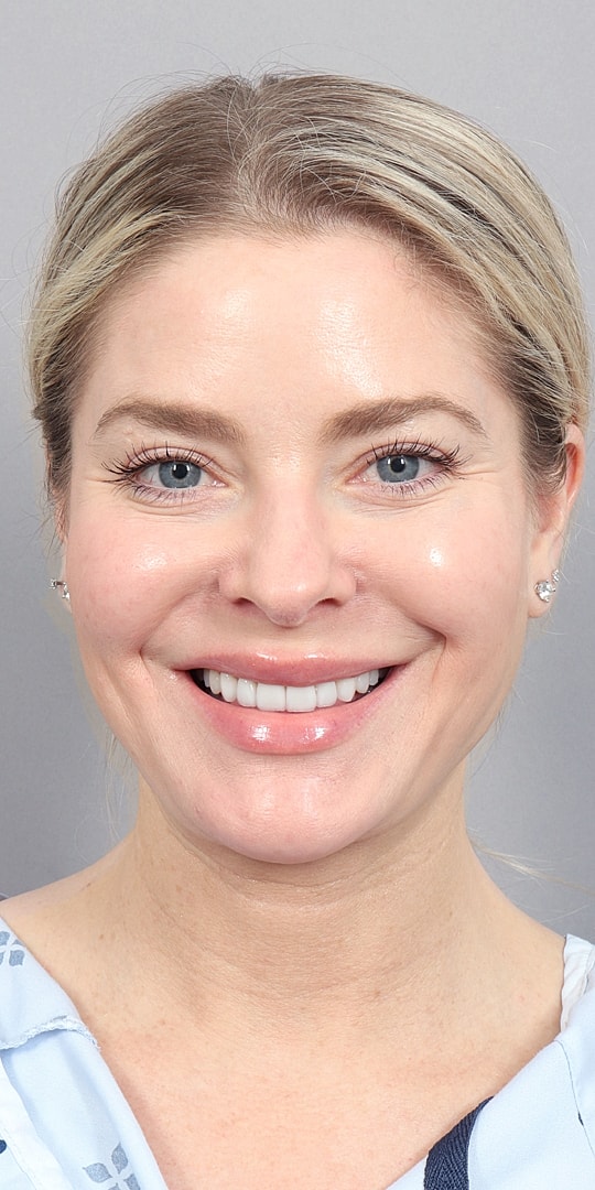 Facelift Before & After