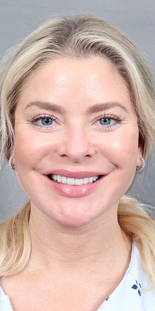 Facelift Before & After