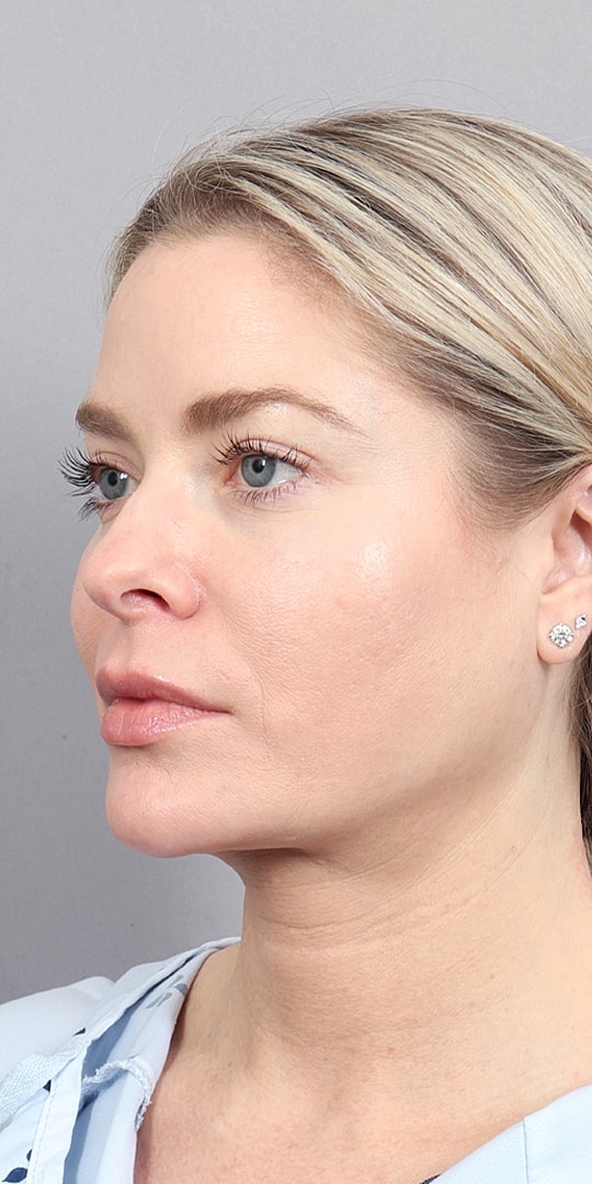 Facelift Before & After