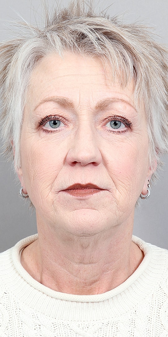 Facelift Before & After