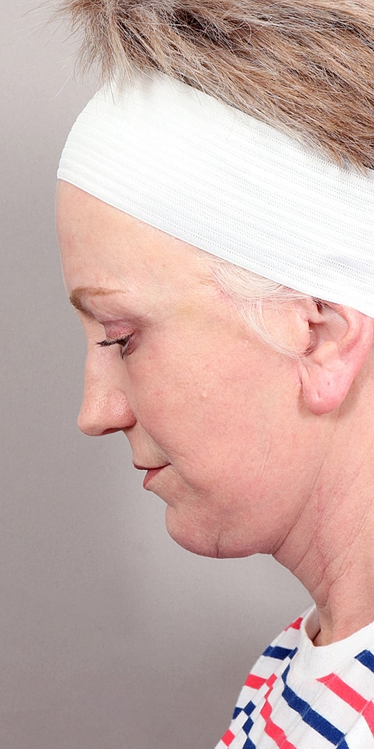 Facelift Before & After