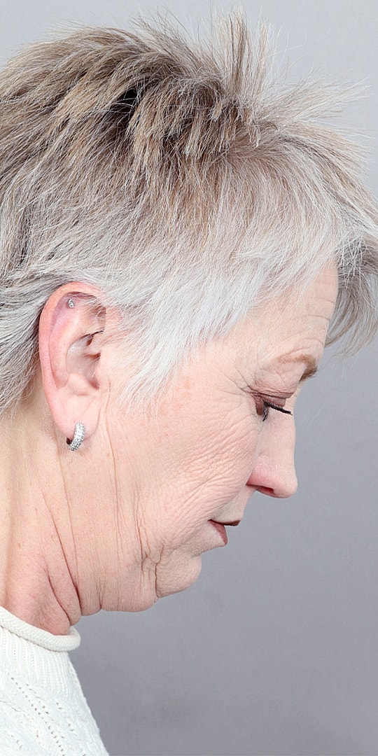 Facelift Before & After