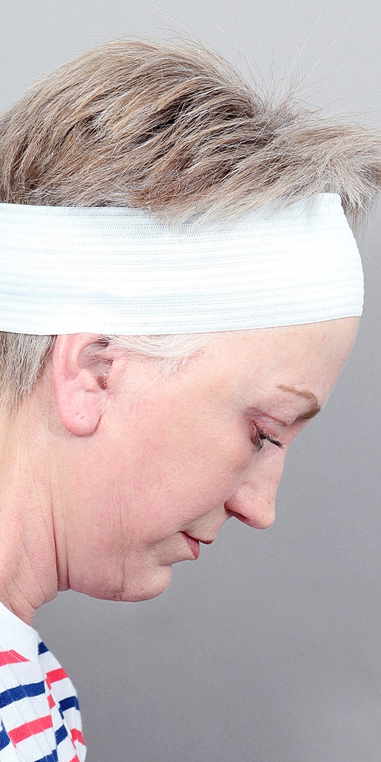 Facelift Before & After