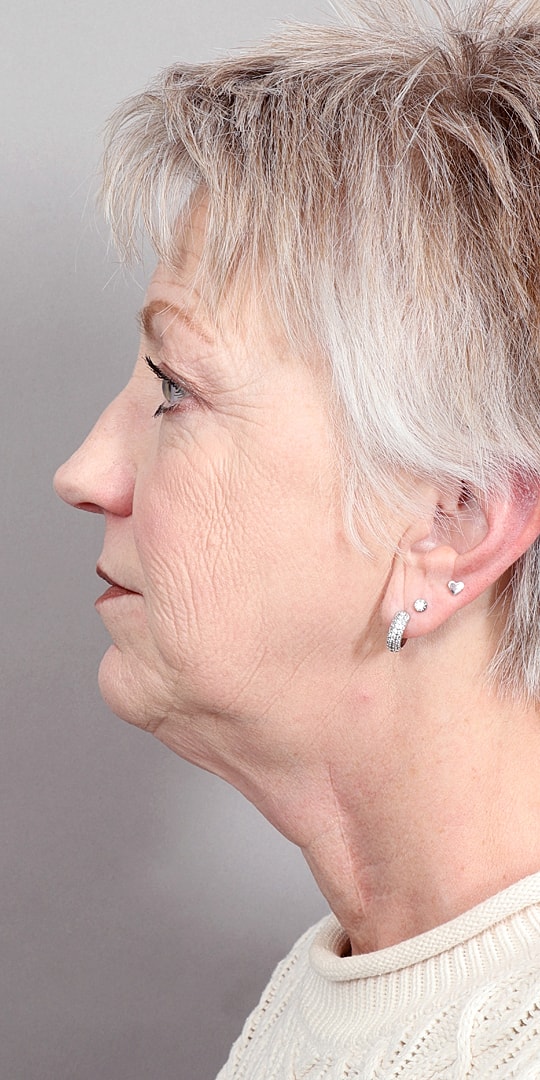 Facelift Before & After