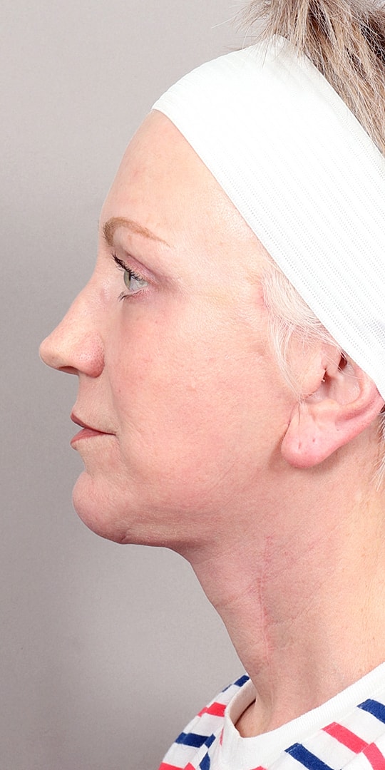 Facelift Before & After
