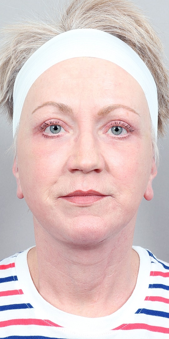 Facelift Before & After