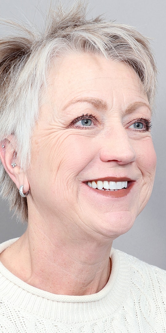 Facelift Before & After
