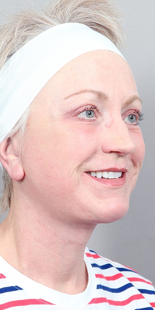 Facelift Before & After