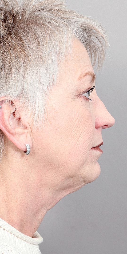 Facelift Before & After