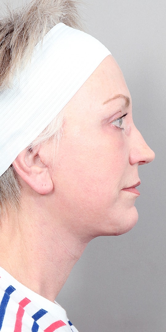 Facelift Before & After
