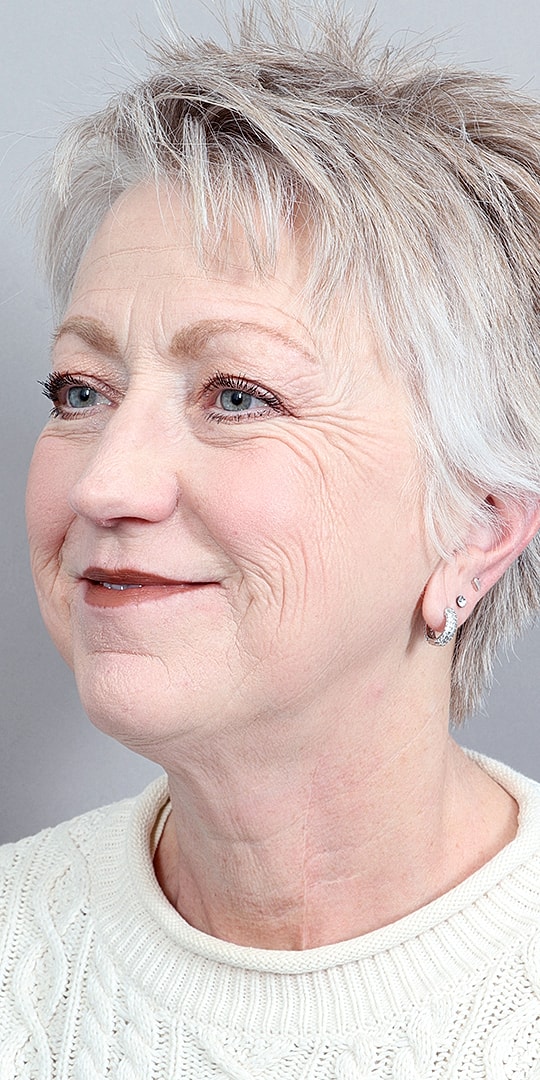 Facelift Before & After