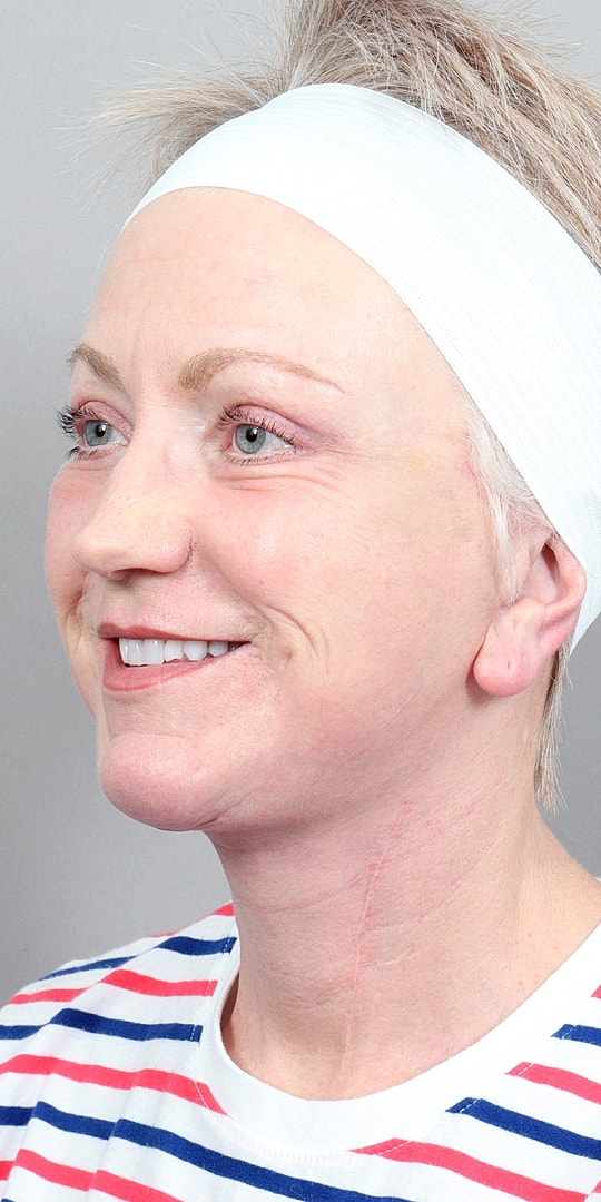 Facelift Before & After