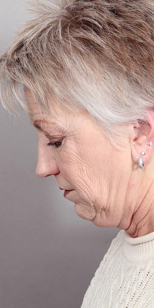 Facelift Before & After