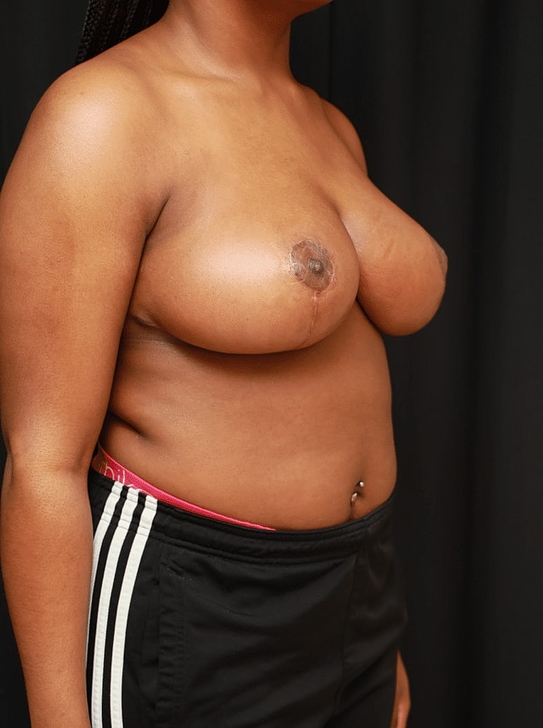 Breast Reduction Before & After