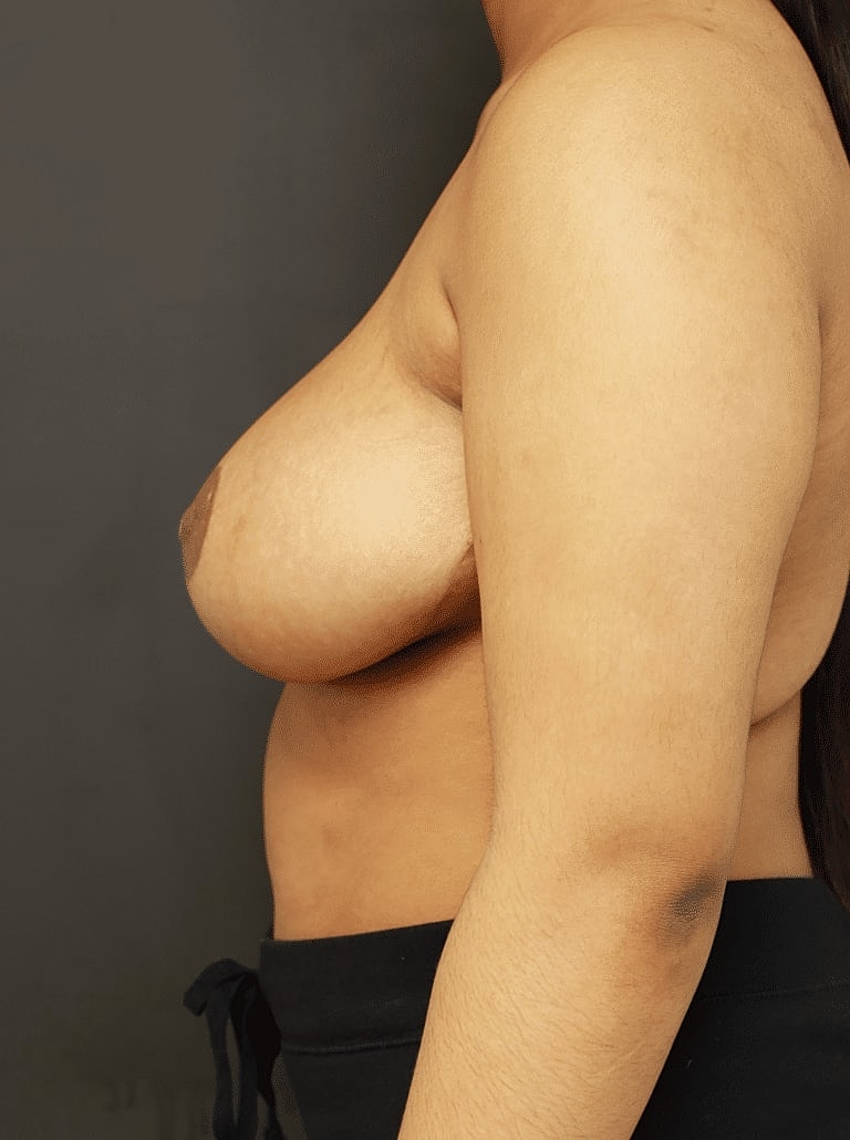 Breast Reduction Before & After