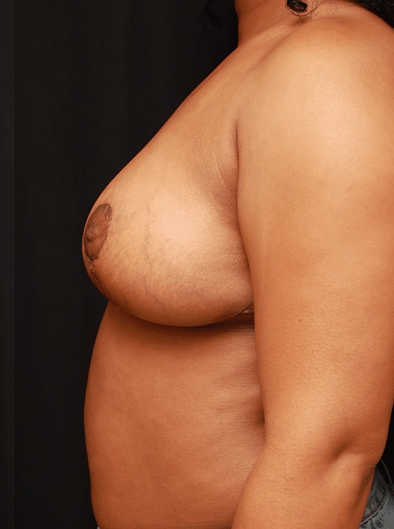 Breast Reduction Before & After